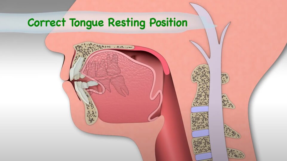 The Effects of Incorrect Tongue Posture